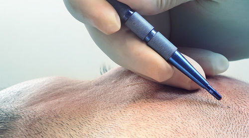 Het laatste nieuws van het bedrijf over Toepassing van saffierbladen bij haartransplantatie